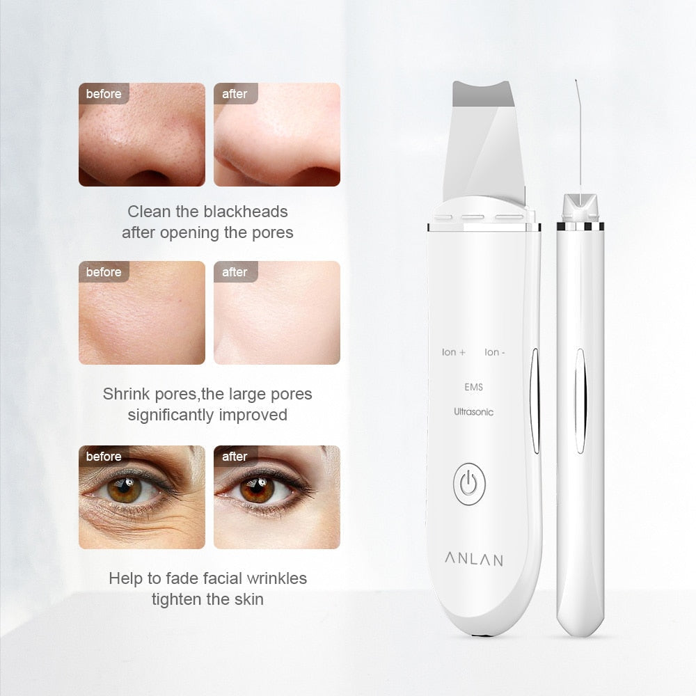 Anlan™-Ultrasonic Skin Scrubber